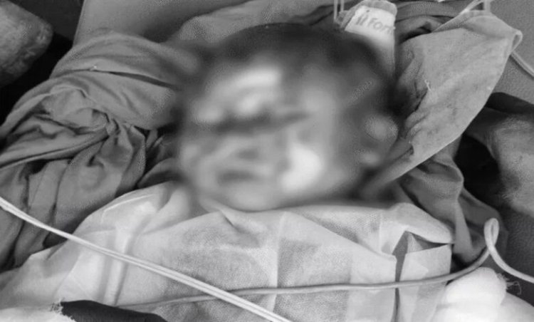 रायगढ़ कार्बन प्लांट हादसा: आग में झुलसी 9 महीने की मासूम की मौत, कई मजदूरों की हालत गंभीर